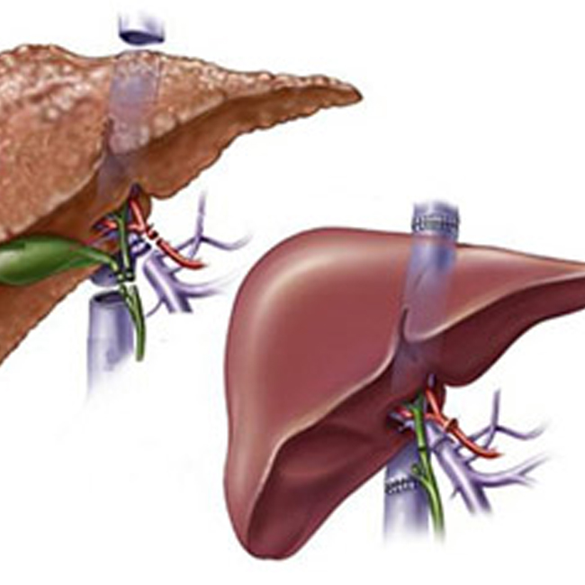 Deceased Donor Liver Transplant